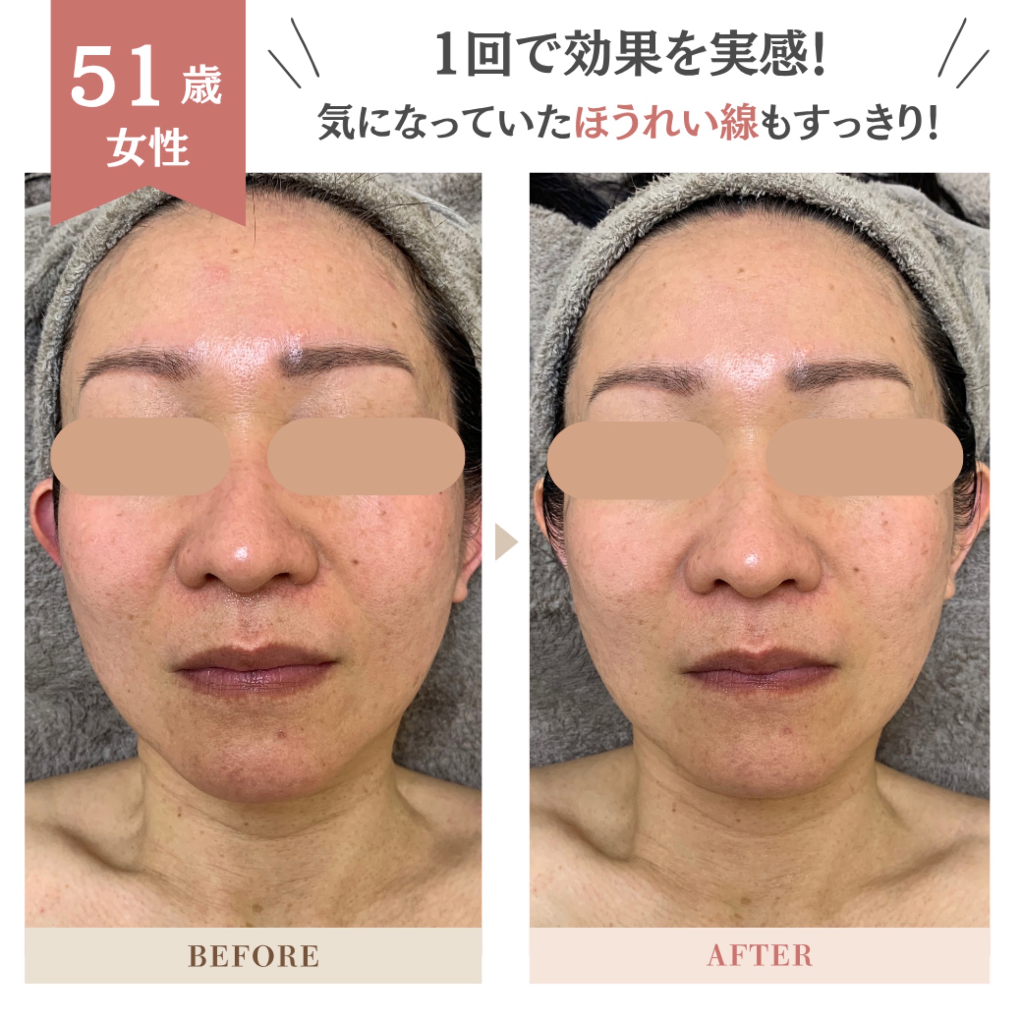 51歳NFフェイシャルビフォーアフター★｜岡崎市の痩身エステ施術例